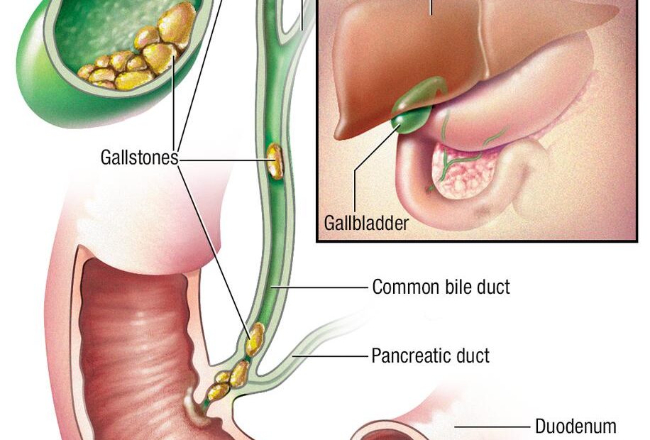 Gallstones - Symptoms & Causes - Mayo Clinic