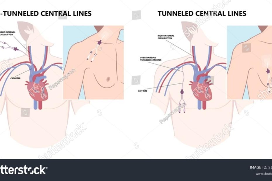 78 Peripherally Inserted Central Catheter Images, Stock Photos & Vectors |  Shutterstock