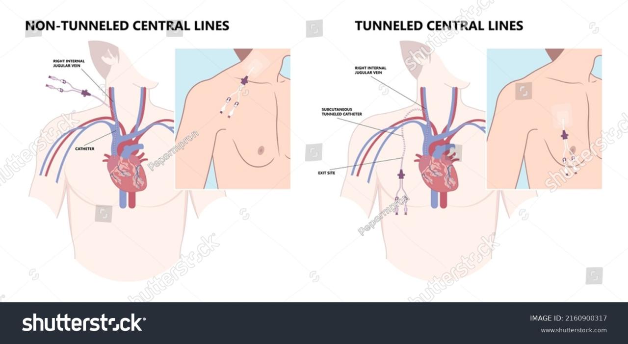 78 Peripherally Inserted Central Catheter Images, Stock Photos & Vectors |  Shutterstock