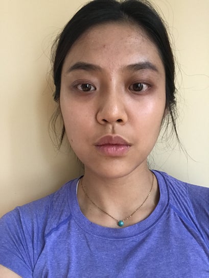 Asymmetrical Face Due To Uneven Fat In Cheeks Or Skin Laxity? Will Buccal  Fat Removal Or Ultherapy Help? (Photo)